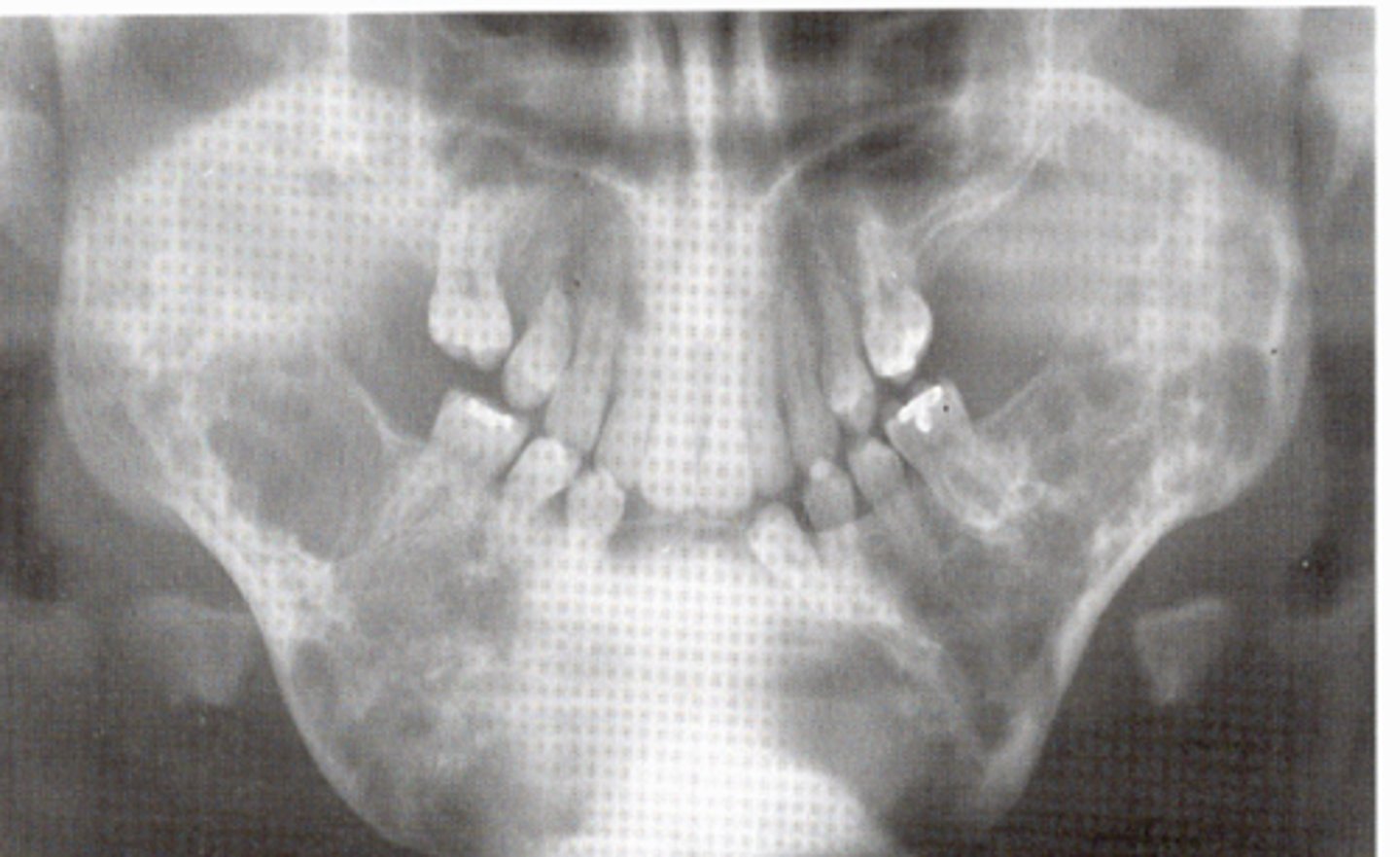 <p>cause: inherited autosomal dominant</p><p>clinical features: plump cheeks; upturned eyes; histologically GIANT CELL LESIONS</p><p>oral features: posterior mndible; usually symmetric</p><p>radiographic: bilateral multiocular lucencies</p><p>population: children</p>
