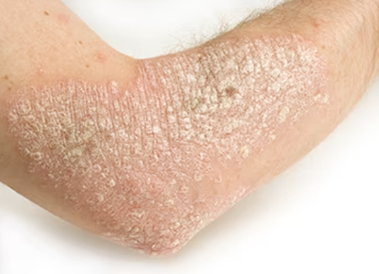<p>what type of secondary skin lesion is this? (change to skins surface)</p>