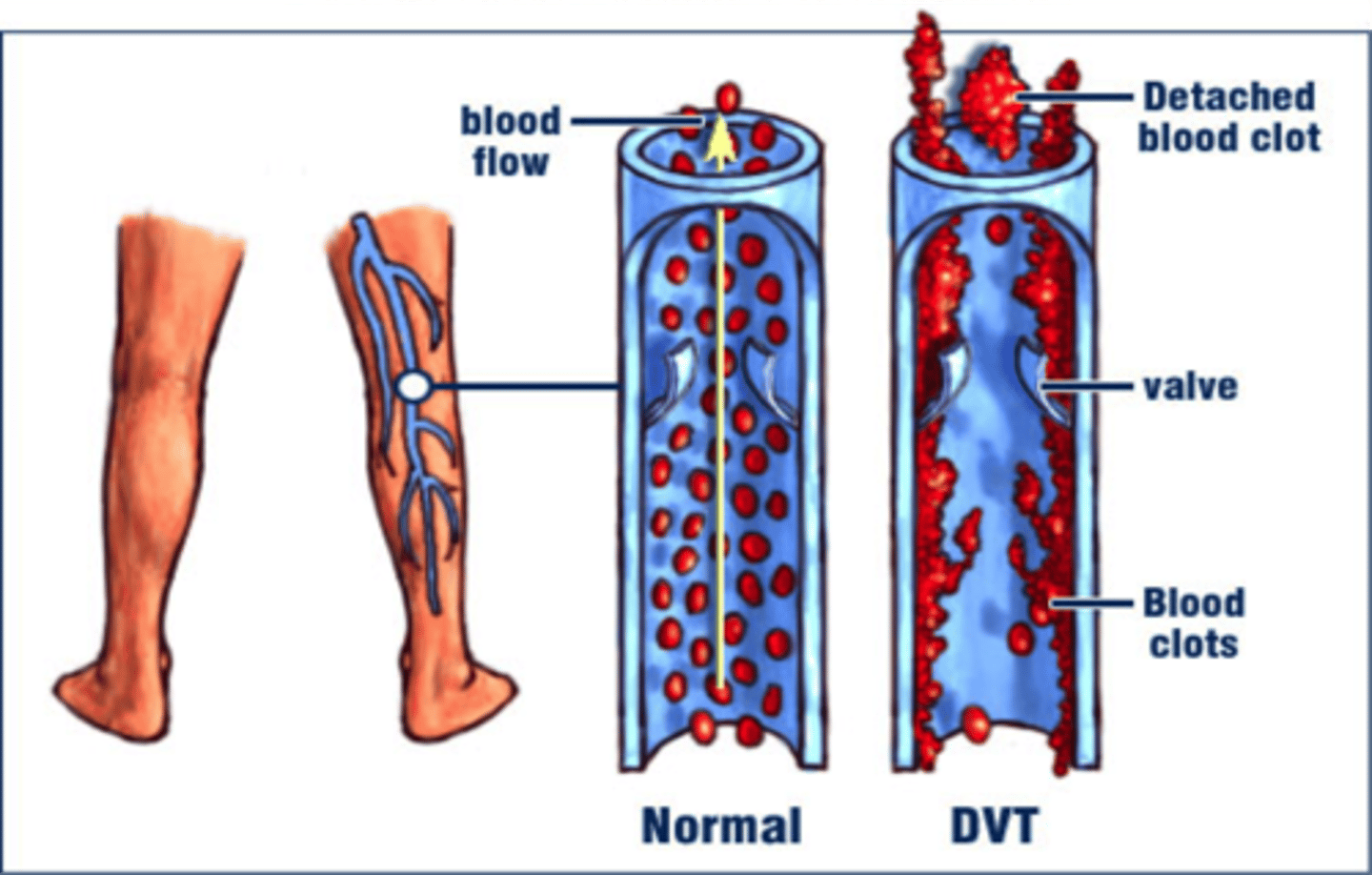 <p>blood clot forms in a large vein, usually in a lower limb</p>