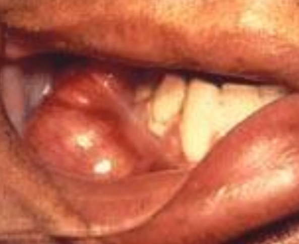 <p>Identify the descriptive term for this lesion</p>