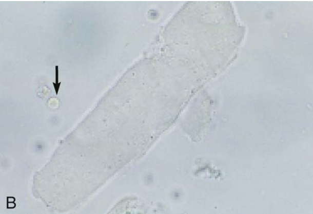 wider than hyaline cast with squared ends and a dull, colorless, gray appearance. Indicate severe, chronic degeneration of the renal tubules