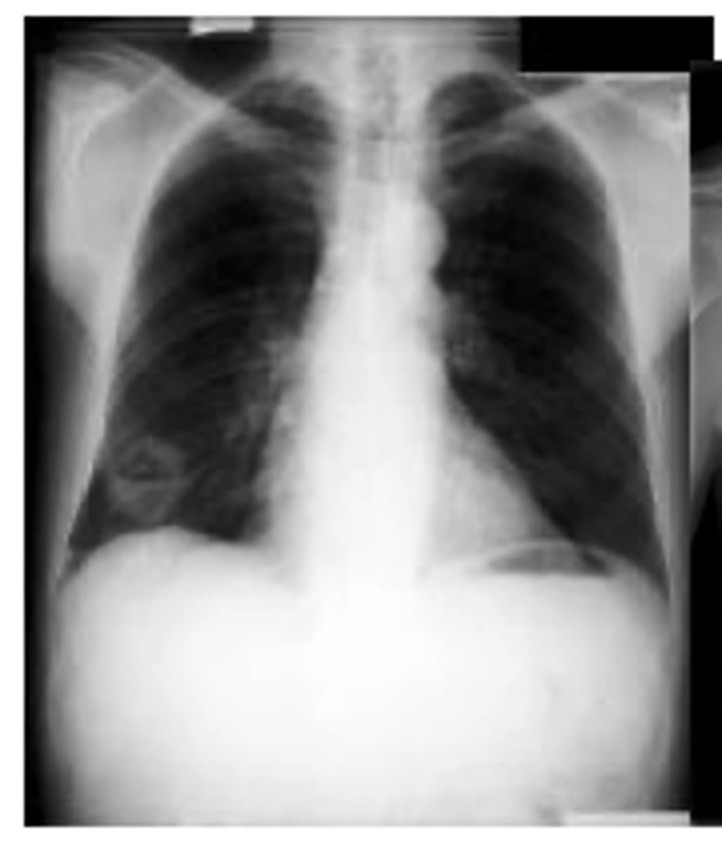 <p>usually occur centrally and tend to cavitate.</p>