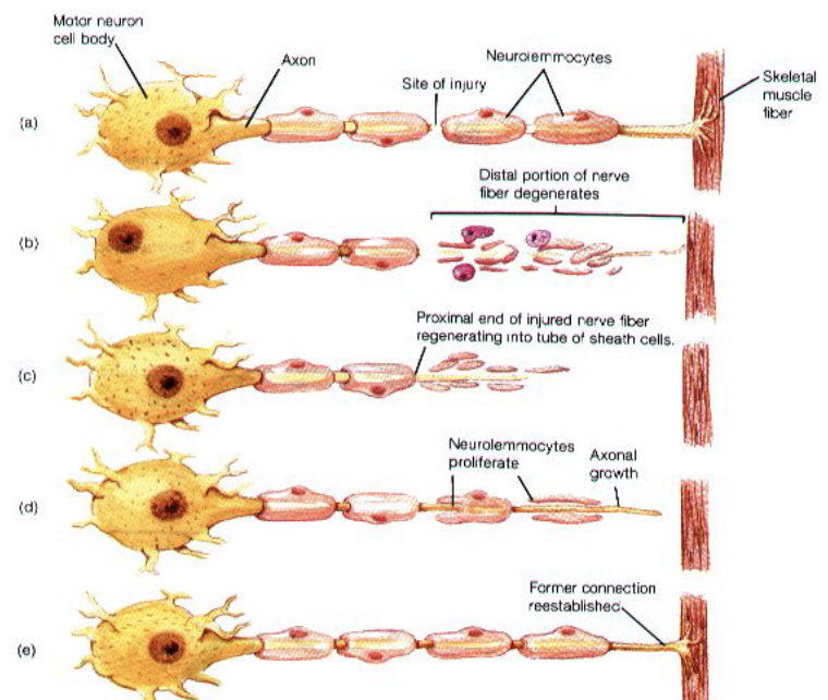 <p>Damage to nerves </p>