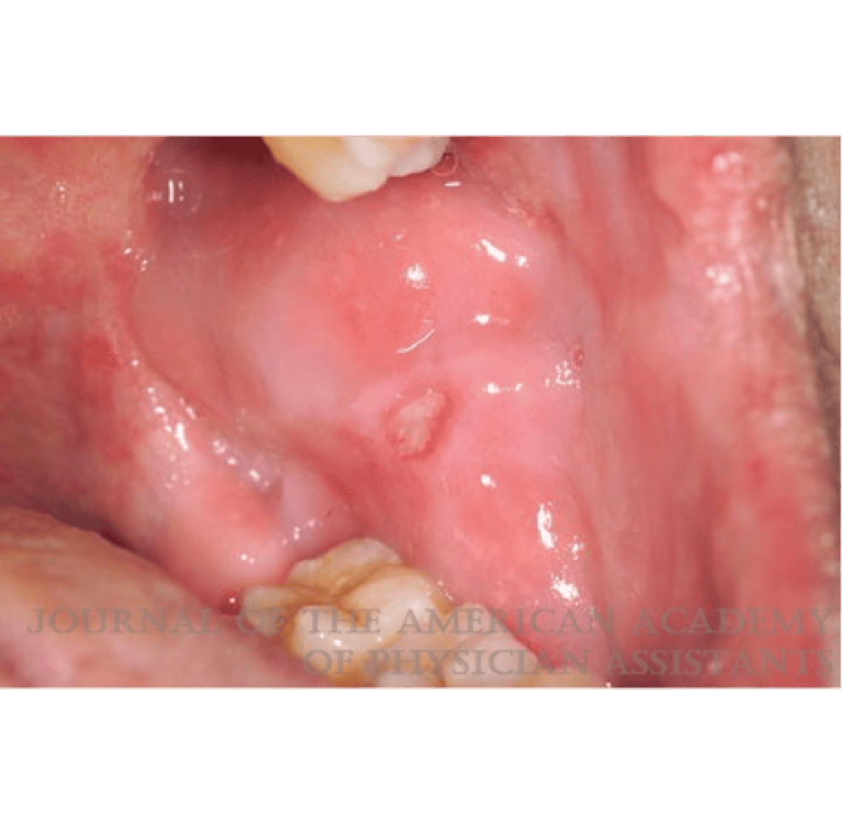 <p>loss of epithelium that extends below the basal cell layer</p><p>ex. canker sore</p>
