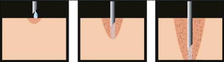 <p>Technique used to minimize pain of greater palatine n block</p><ul><li><p>Bevel towards tissue and force L.A in before needle enters</p></li></ul><p></p>