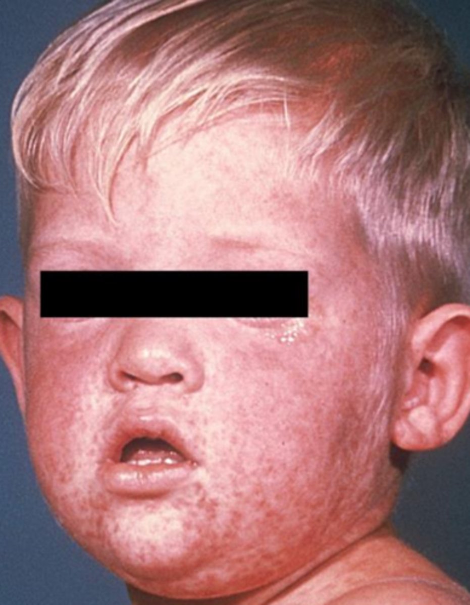 <p>measles</p>