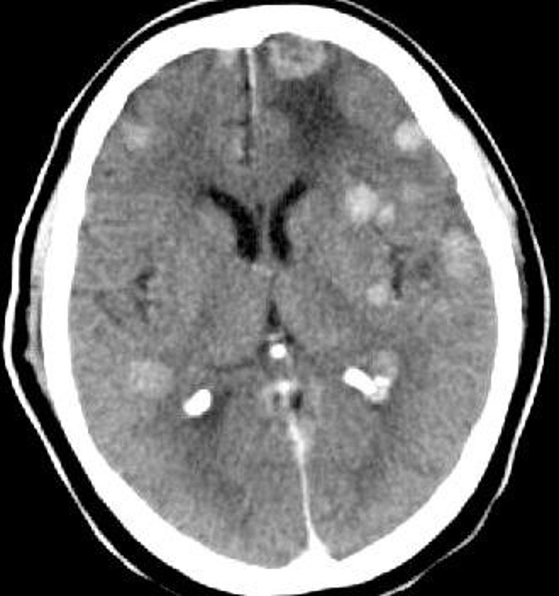 <p>The spreading of a primary tumor to the brain.</p><p>- usually from Lung, breast, kidney cancers</p><p>- common place of metastases</p>