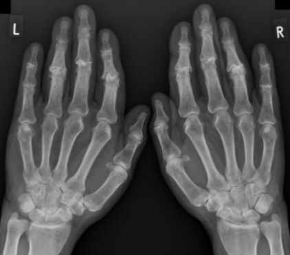 <p>has similar finings to primary osteoarthritis but tends to feature more inflammatory changes</p><ul><li><p>occurs typically <strong>centrally located within the joint </strong></p></li><li><p><span style="color: blue;"><strong><mark data-color="blue" style="background-color: blue; color: inherit;">inflammation &amp; synovial proliferation</mark></strong></span></p><ul><li><p>pannus formation</p></li><li><p>produces lytic lesions near joint</p></li></ul></li><li><p>examples:<span style="color: red;"><strong><mark data-color="red" style="background-color: red; color: inherit;">rheumatoid arthritis, gout, psoriasis </mark></strong></span></p></li></ul><p></p>