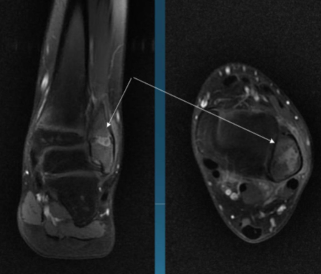 <p>Describe the pathology indicated by the arrow (Cor T1 FS +C). </p>