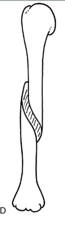 <p><strong>Which fracture?</strong></p>