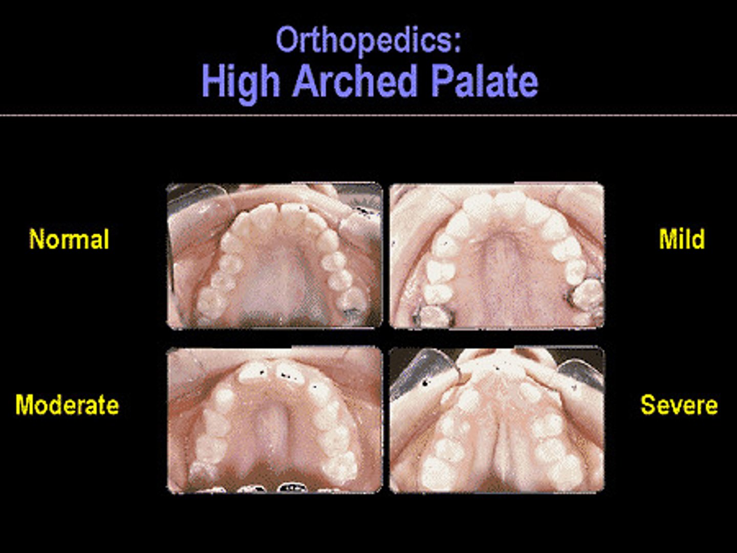 <p>Palate (roof of mouth)</p>