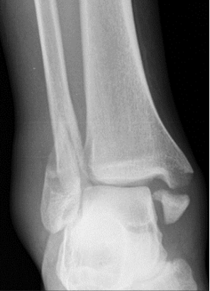 <p>What type of fracture is this?</p>