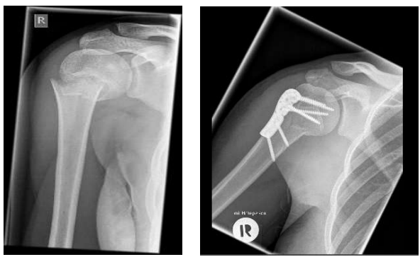<p>Besonderheit Winkelstabile Platte</p><ul><li><p>in Plattenlöchern gewinde eingebaut die zu Schrauben passen</p></li><li><p>Schrauben können sich weniger bewegen → stabilere Osteosynthese</p></li><li><p>Nachteil: zu stabil - Platten Wandern aus und Schrauben evtl die Knochen</p></li></ul><p></p>