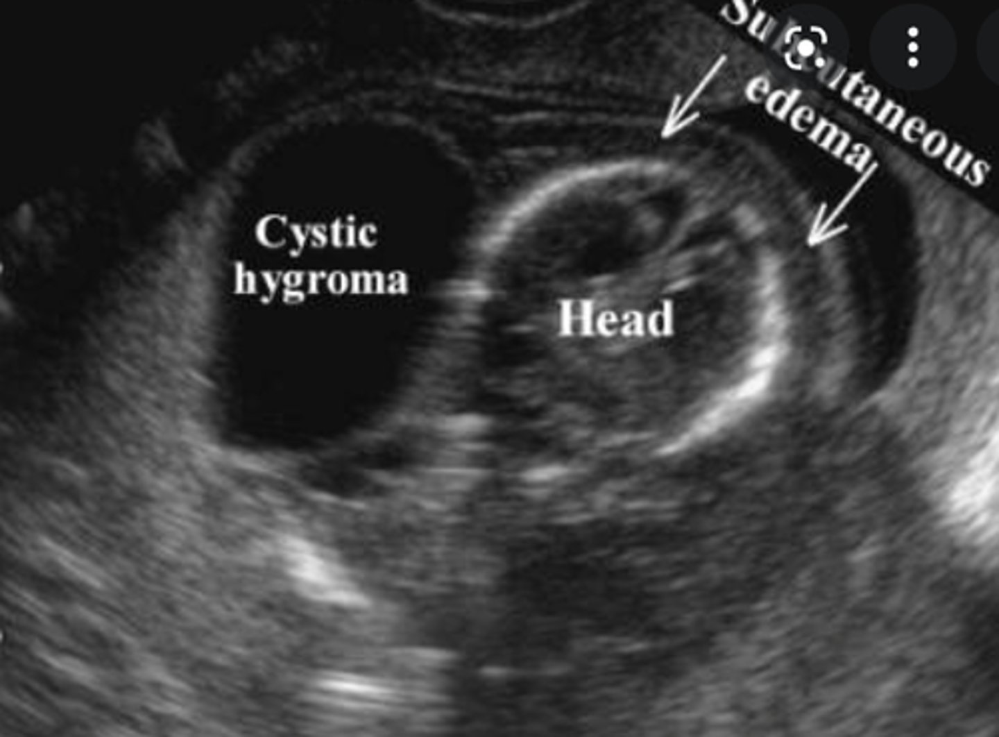 <p>Etiology</p><p>-Inadequate drainage of lymph fluid into the jugular vein </p><p>-Increased secretion from the epithelial lining</p><p>-Associated with Turners syndrome</p><p>Clinical findings</p><p>-Asymtpomatic</p><p>-Posterior neck mass</p><p>Sonographic findings</p><p>-Thin-walled, multilocular cystic structure </p>