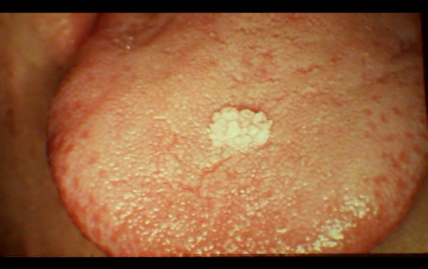 <p>Caused by HPV</p><p>Often found in soft palate and uvula</p><p>May need to be excised</p><p>Cauliflower-like</p><p>Peduculated-stalked</p><p>Usually does not recur</p>