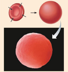 <p>Les cellules absorbent de l’eau par osmose, enflent et risquent d’éclater (lyse) dans une solution hypotonique (concentration de soluté non diffusible inférieure à celle présente dans les cellules). </p>