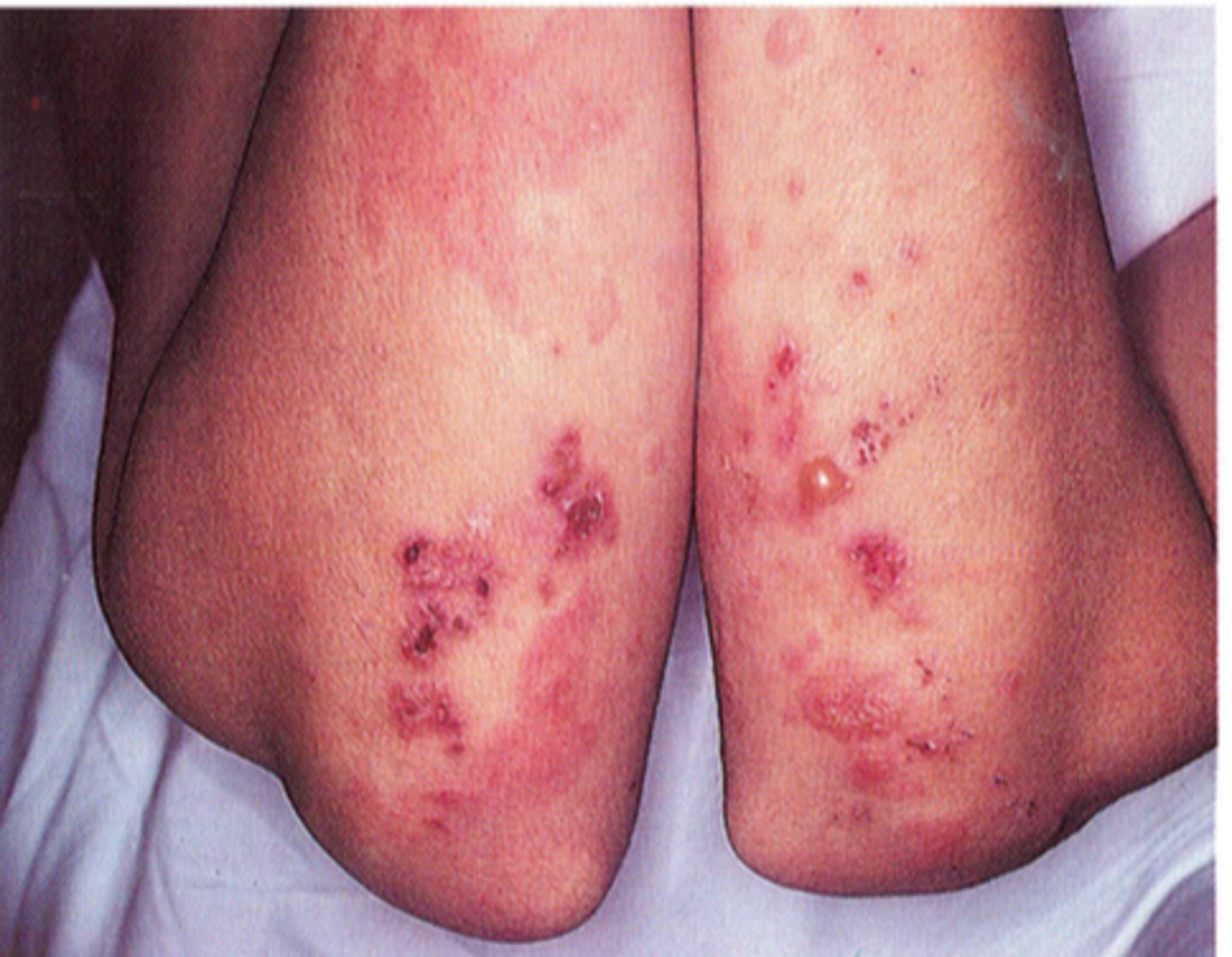 <p>Dermatitis Herpetiformis</p>
