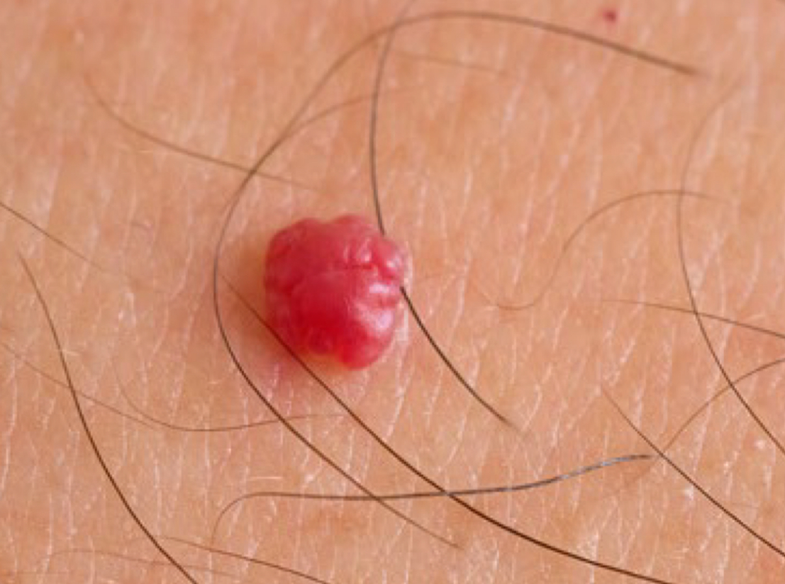 <p>what type of color change and condition is depicted</p>