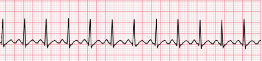 <p>Determine the sinus node arrhythmia:</p><p>A faster-than-normal heart rate, usually &gt;100 bpm, with regular rhythm.</p>