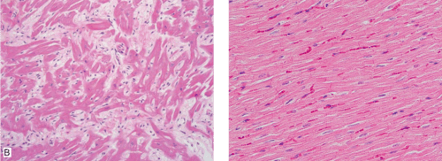 <p>Why is the image on the left not normal myocardium?</p>
