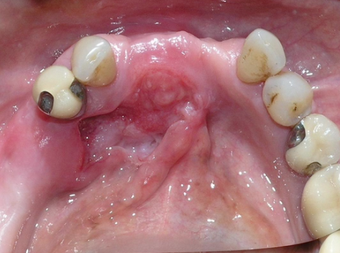 <p>What are some high risk sites of Squamous Cell Carcinoma (SCC)?</p>