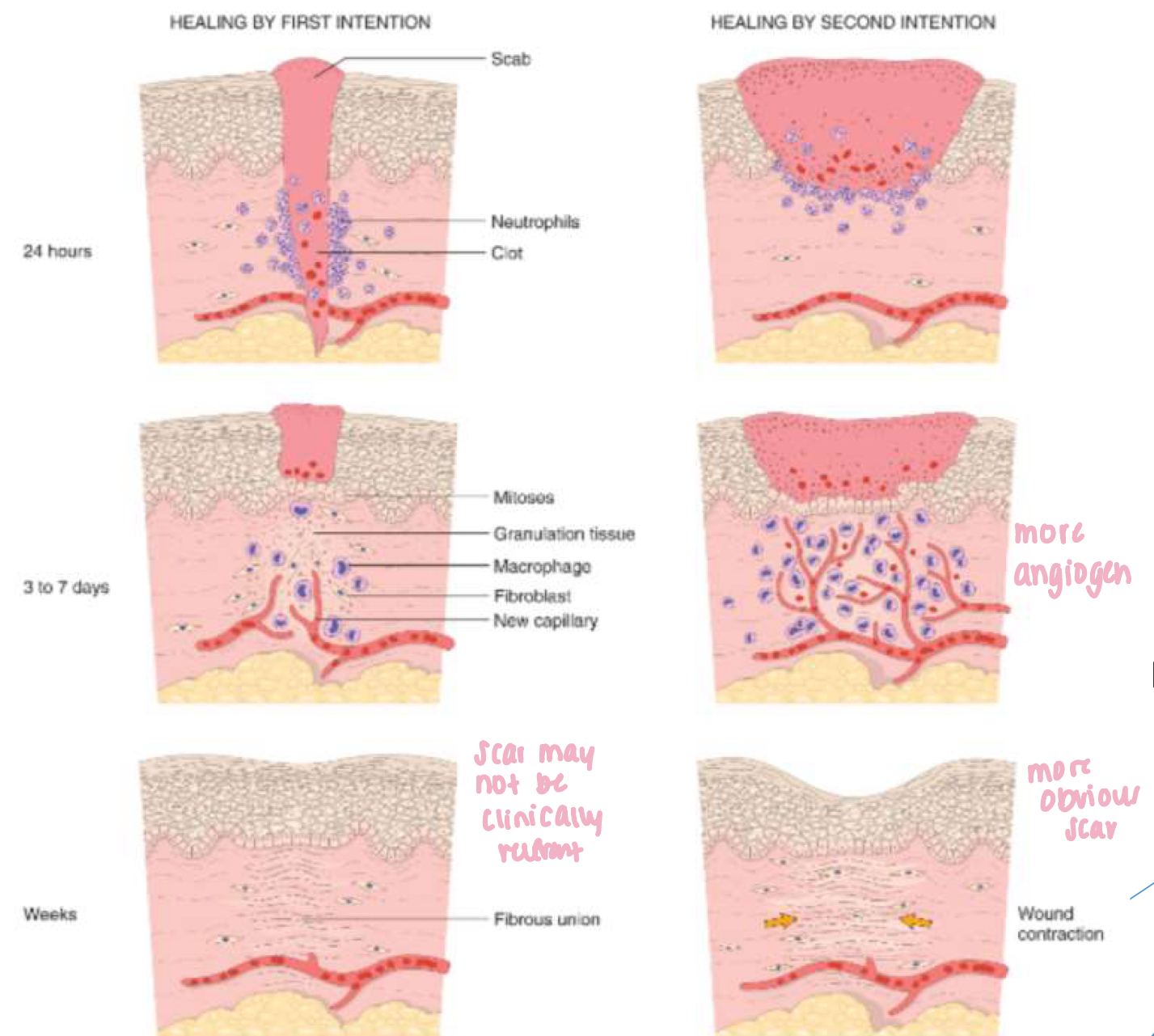 <ul><li><p>larger clot</p></li><li><p>more intense inflam</p></li><li><p>more granulation tissue</p></li><li><p>wound contraction: w/in 6 weeks large wounds reduced 5-10% their original size</p></li></ul><p></p>