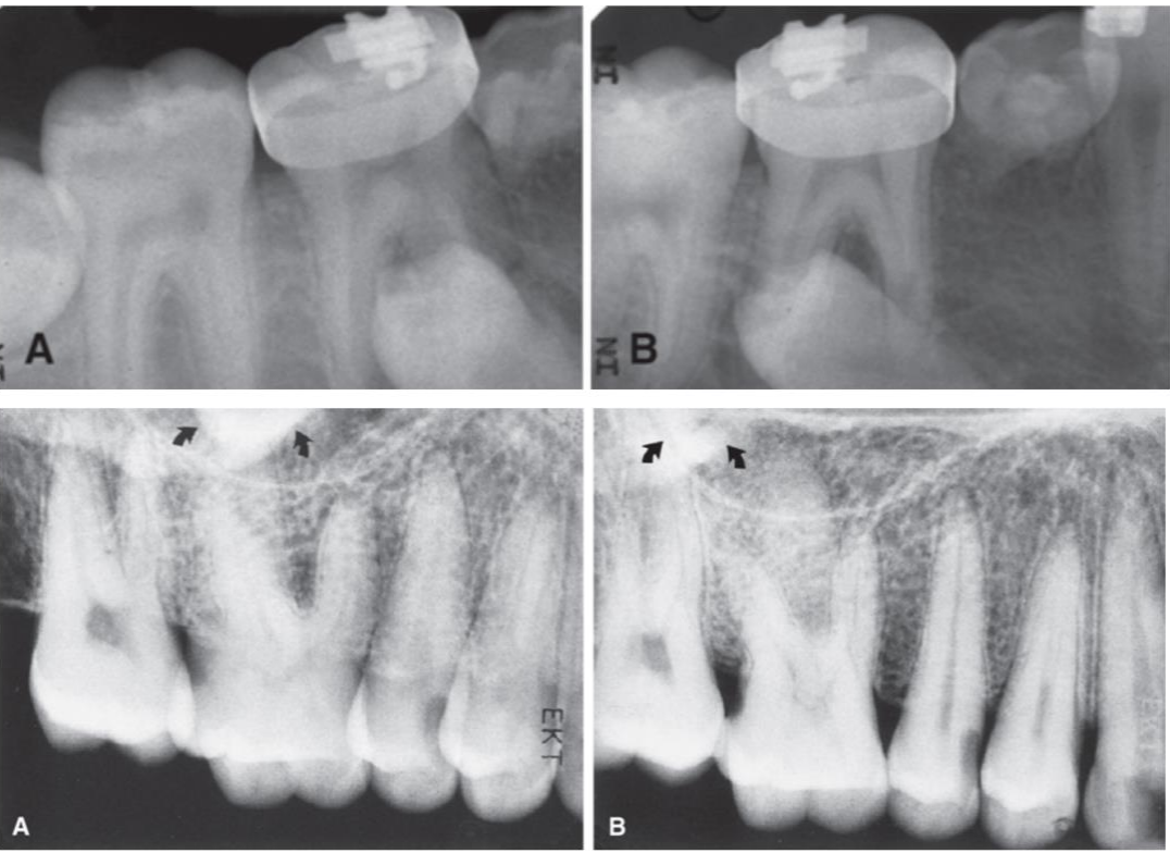 <p>Buccal objects shift in the opposite direction from the tube</p><p>From image A to B, bracket shifts distally, so, the tube must be shifting mesially</p>