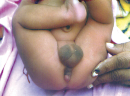 <p>CASE: (Check the picture) This is a case of “Penoscrotal (Penis + Scrotum) Transposition” or a complete congenital positional exchange between Scrotum and Penile Shaft. This is due to an insult to which embryonic structure?</p><p>A. Cloacal Folds</p><p>B. Wolffian Duct</p><p>C. Indifferent Gonad</p><p>D. Müllerian Duct</p>