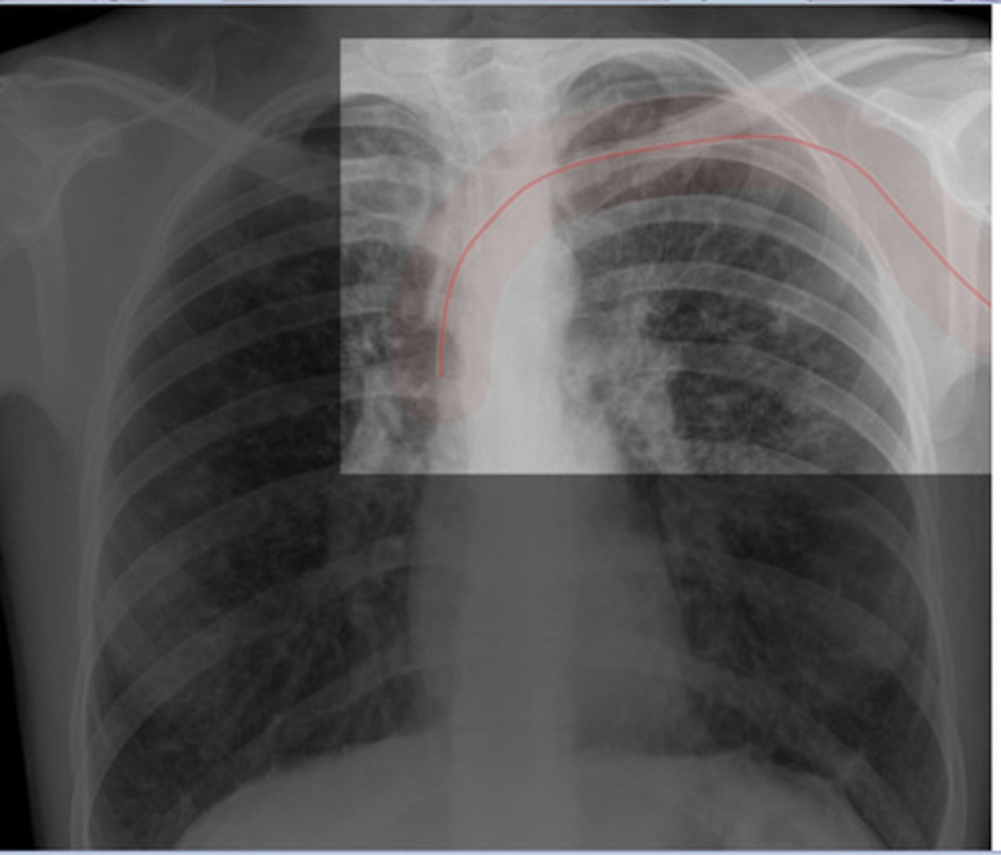 <p>PICC line</p>