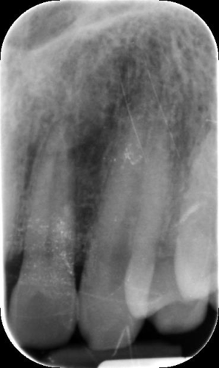 <p>Not routinely seen on the canine projection due to overlap of the lingual cusp of the first premolar</p>