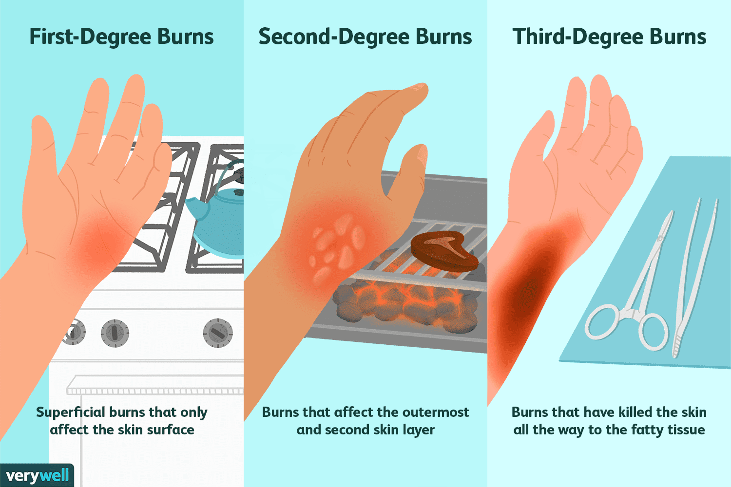 <p>Second Degree Burn</p>