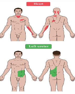 <p>pain that is perceived to originate from one body region, but truly originates from another&nbsp;</p><ul><li><p>HA</p></li><li><p>gallbladder</p></li></ul><p></p>