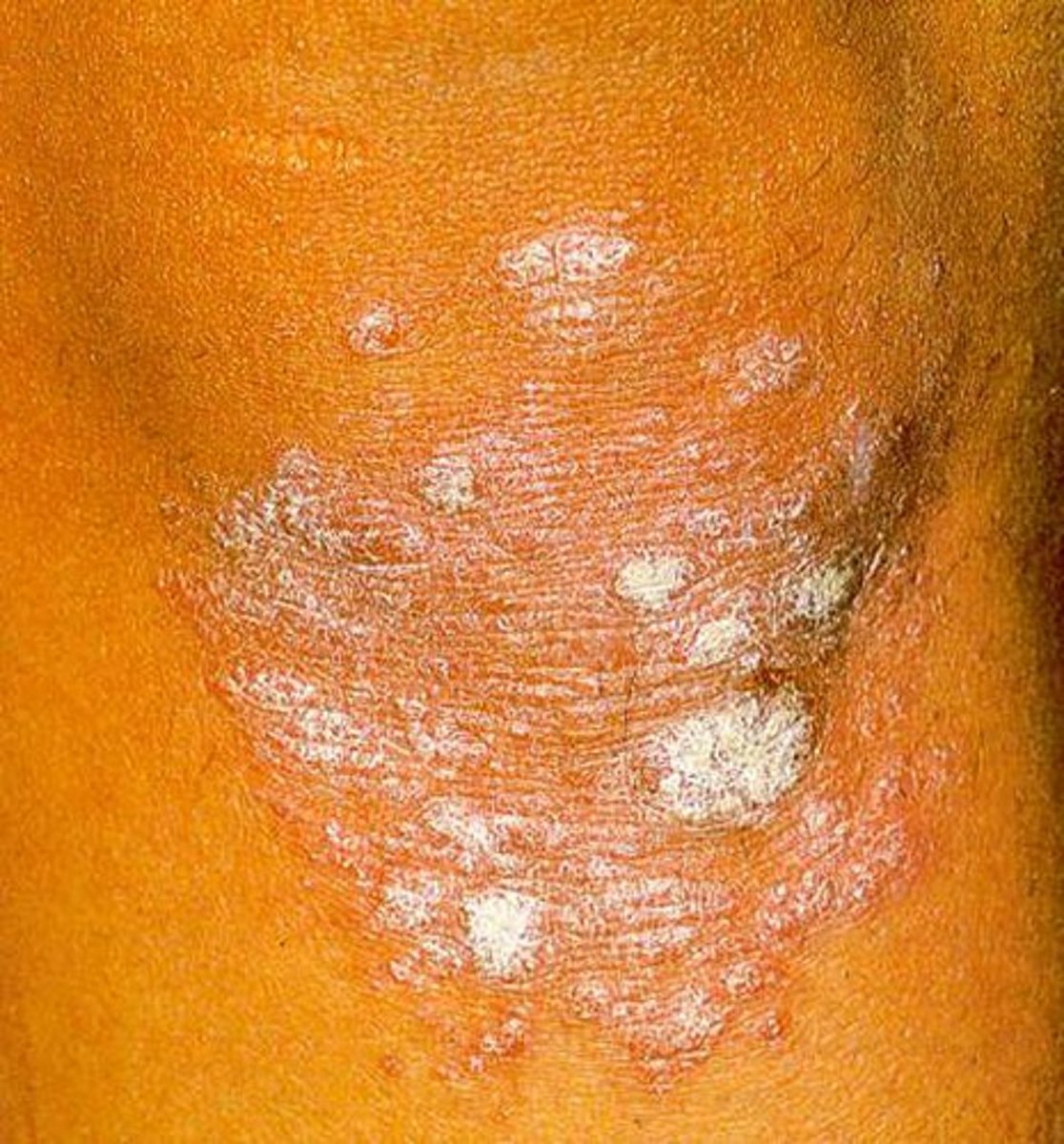 <p>Scalp, elbows, knees, lower back, buttocks</p>