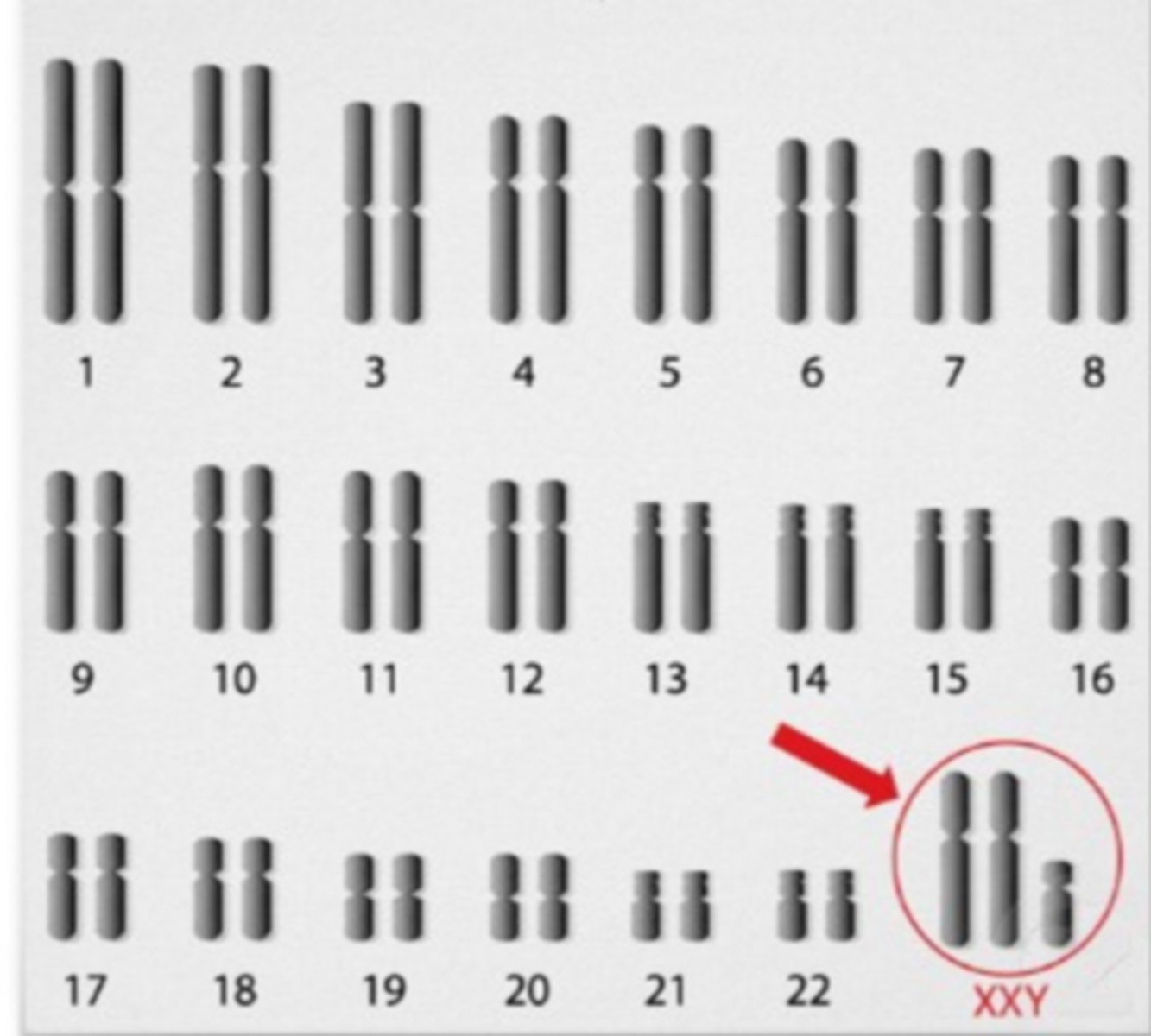 <p>One of most common genetic disorders; male babies are born with an extra X chromosome but typically no symptoms are apparent until puberty; referred to as trisomy 23 (XXY); affects 1 out of every 500 - 1000 males; the extra X chromosome primarily affects the testes, which produce sperm and the male hormone testosterone; lack of testosterone prevents males from exhibiting secondary sex characteristics like facial and body hair and most are sterile; individuals affected are often less muscular, may have learning disabilities; often treated with hormone replacement therapy</p>