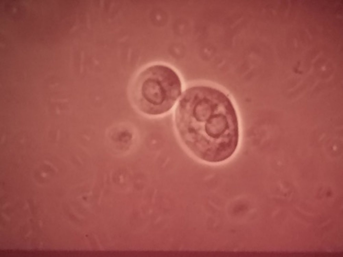 <p>These cells differ in size depending on the area that they originated from. They can also absorb things like bilirubin and turn yellow or contain hemosiderin granules from iron breakdown.</p><p>- Most have coarsely granular cytoplasm and often resemble casts (but casts would NOT contain a nucleus)</p><p>- PCT: are larger and tend to have a rectangular shape (columnar or convoluted cells)</p><p>- DCT: are smaller and are round/oval in shape and can be confused with transitional epithelial cells. BUT transitional cells have a centrally located nuclei where as RTE cells have an eccentrically located nuclei</p><p>Clinical Significance: Increased presence is indicative of necrosis of the renal tubules, with the possibility of affecting overall renal functions.</p><p>- Due to: exposure to heavy metals, drug-induced toxicity, hemoglobin/myoglobin toxicity, viral infections, pyelonephritis, malignant infiltrations or transplant rejections</p>