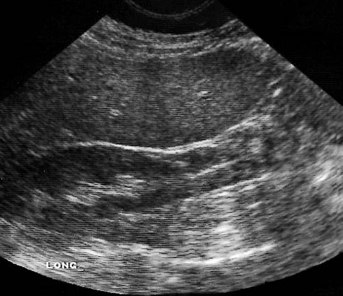 <p><span>A female patient presents with a history of post- prandial pain. The left lobe of the liver does not extend across the midline. This image of the right lobe is most likely demonstrating which of the following conditions?</span></p>