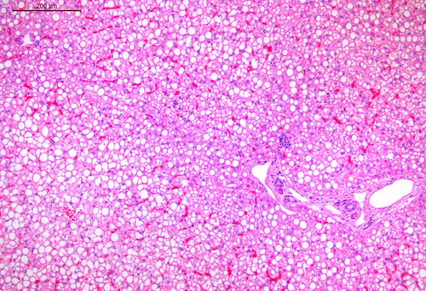 <p>Identify the microscopic pathology of the liver?</p>