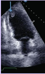 <p>More than one surface of the thrombus is exposed to the blood pool.</p>