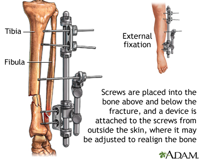 <p>Used to realign a fracture (broken bone)</p>
