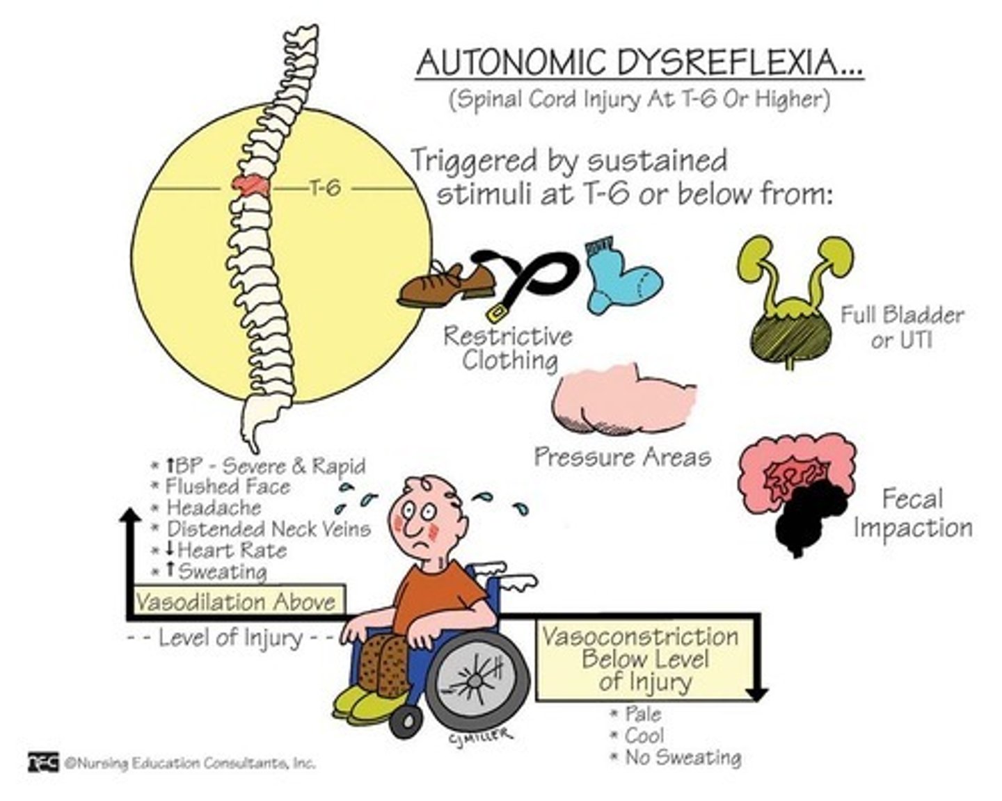 <p>Massive uncompensated cardiovascular reaction mediated by sympathetic nervous system</p><p>- SNS responds to stimulation of sensory receptors - parasympathetic nervous system unable to counteract these responses.</p><p>- Hypertension and bradycardia</p><p>Causes: Kinked catheter, Tight clothes, Fecal impaction, Kidney stones</p><p>- Results In: Flushing above injury, Decrease in HR, Increase in BP</p>
