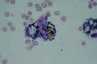 Figure 13: Macrophage containing hemosiderin and hematoidin crystals