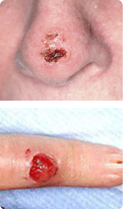 <p>skin defect with loss of epidermis only and heals WITHOUT a scar</p>