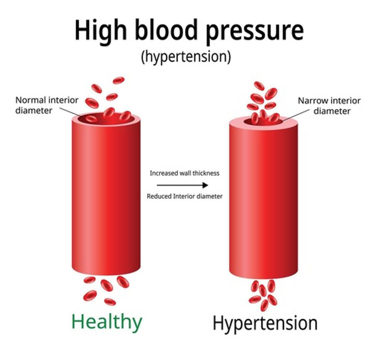 <p>Sustained elevated blood pressure in arteries.</p>