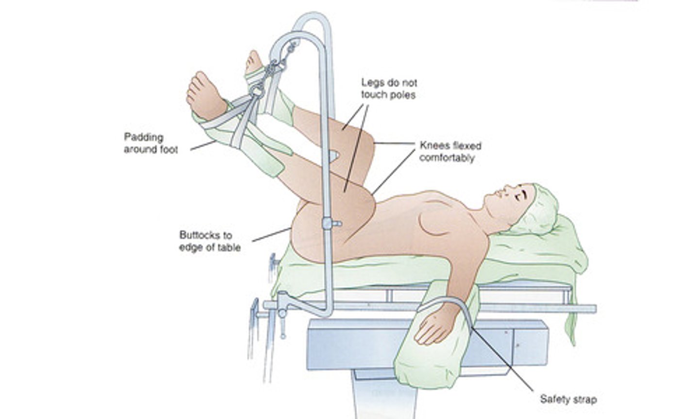 <p>lithotomy → commonly used during uro/gyn surgery***</p>