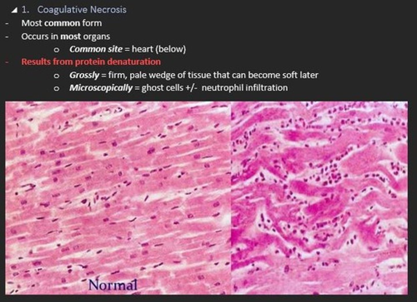 <p>Coagulative necrosis </p><p>- Occurs in most organs</p><p>- Results from protein denaturation</p>