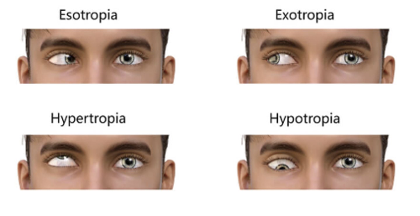 <p>-Ocular misalignment where one eye is fixating</p><p>-Other eye is deviating</p>