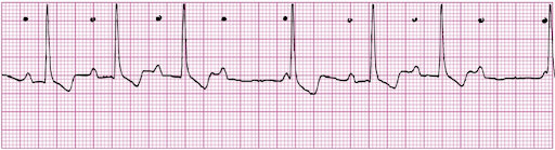 Rate: atrial 60 – 100, ventricular – varies

Regularity: irregular. Group of beats, then a pause

P waves: upright, matching, one blocked

PR: gradually prolonging PR intervals until a QRS is dropped

QRS: < 0.12 secs