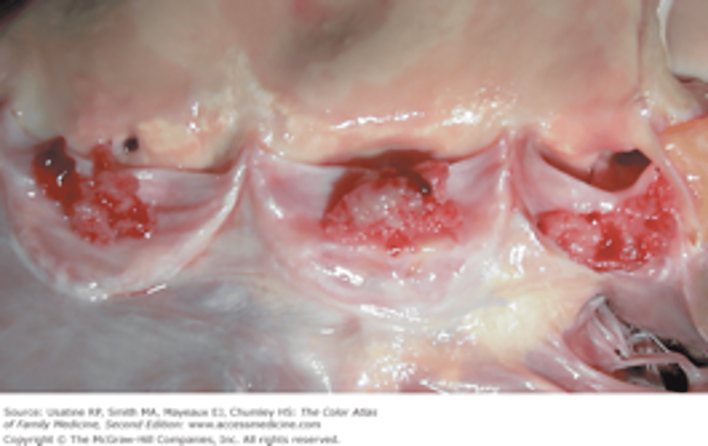 <p>inflammation of heart chambers.</p>