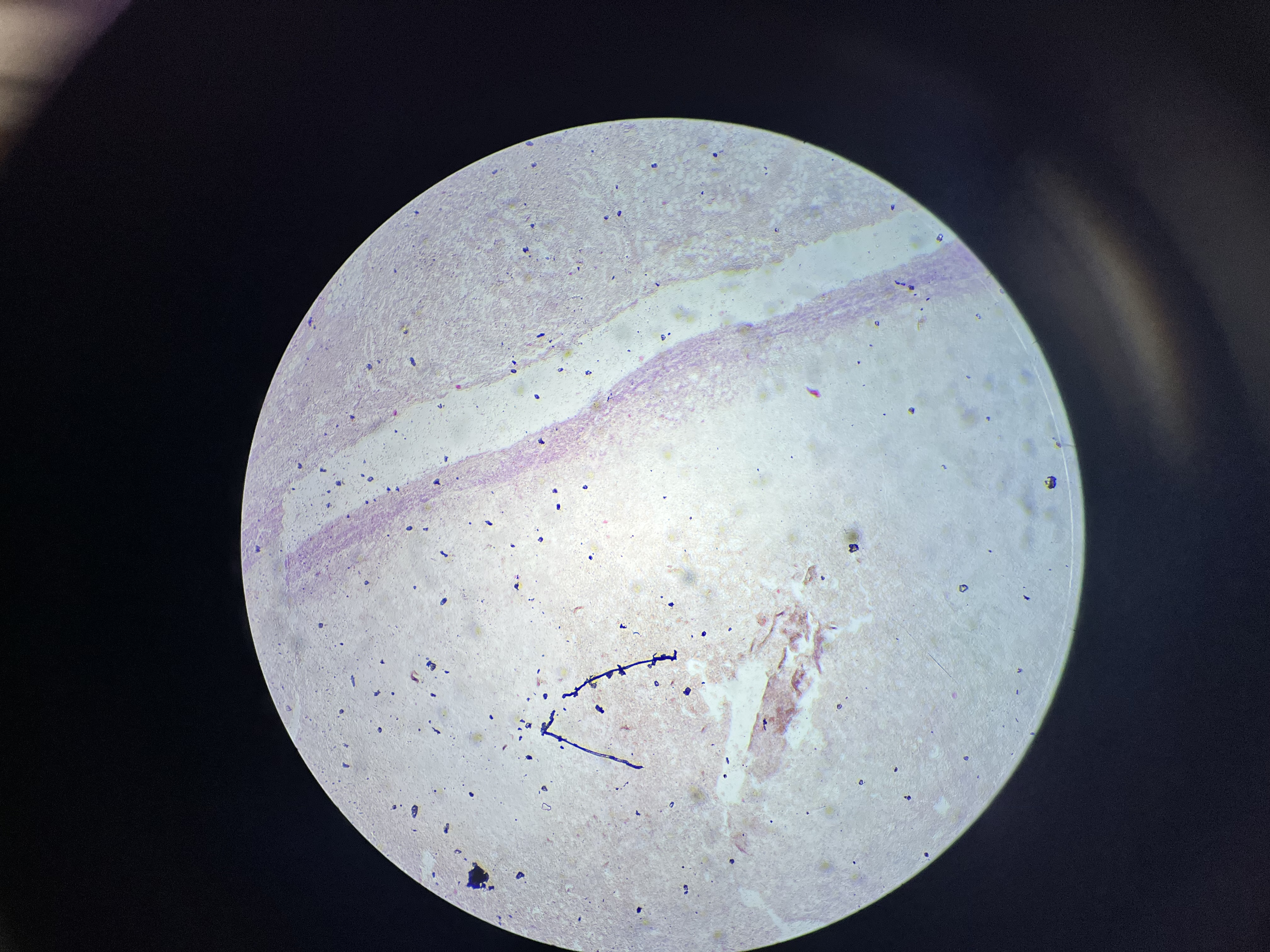 <p><span>A severe form of adrenal hemorrhage typically associated with infection, most commonly Neisseria meningitidis, leading to adrenal gland failure and often causing shock due to the rapid loss of adrenal hormones.</span></p>
