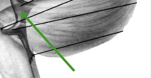 <p>unpaired; located dorsal to pons and rostral medulla; has openings that allow the movement of CSF to the outside of brain and spinal cord </p>
